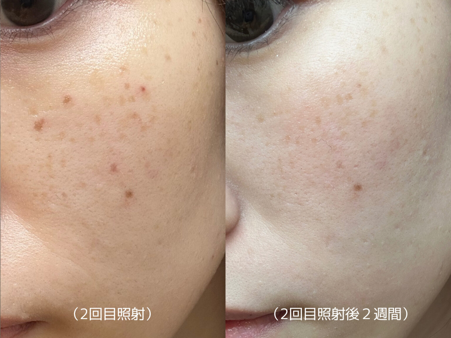 【大阪・美容クリニック】よつば会クリニックでのシミ取りレビュー - おもち.com